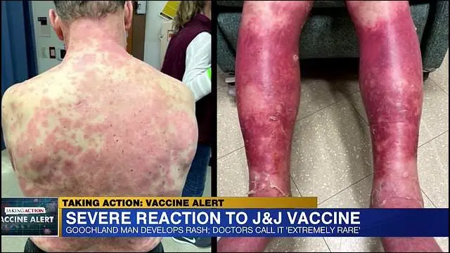 Why We See Massive Skin Peels On J&J Vaxxed People