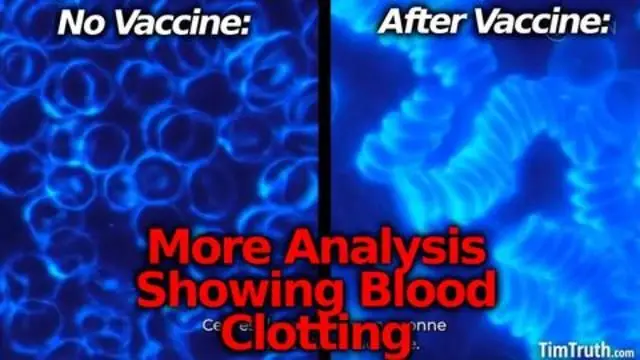 More Vaccine Bloodwork: Blood Cells Reportedly Clotting After Vaccine #ClotShot #Nuremberg2