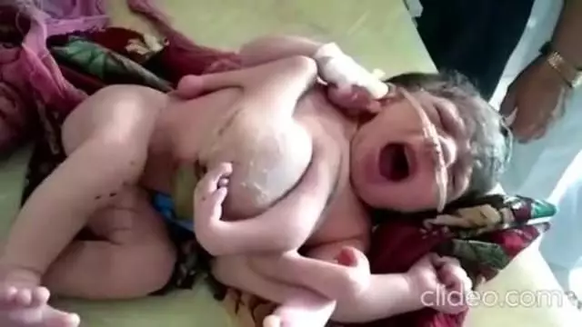 Mutant Vax Babies Being Born After Mothers Receive The Abomination-Jab