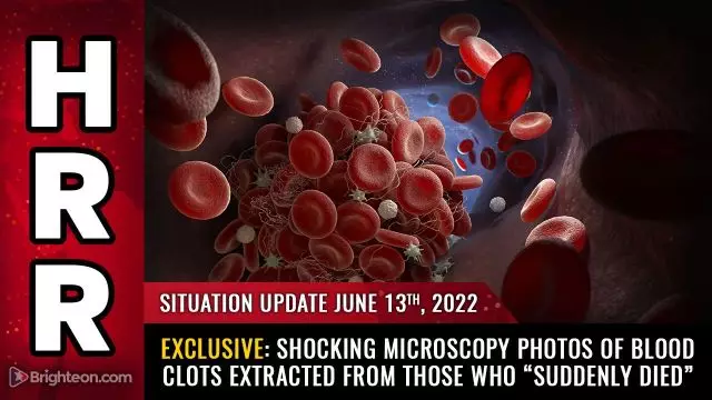 Situation Update, June 13, 2022 - EXCLUSIVE: Shocking microscopy photos of fibrous clots extracted from those who “suddenly died”